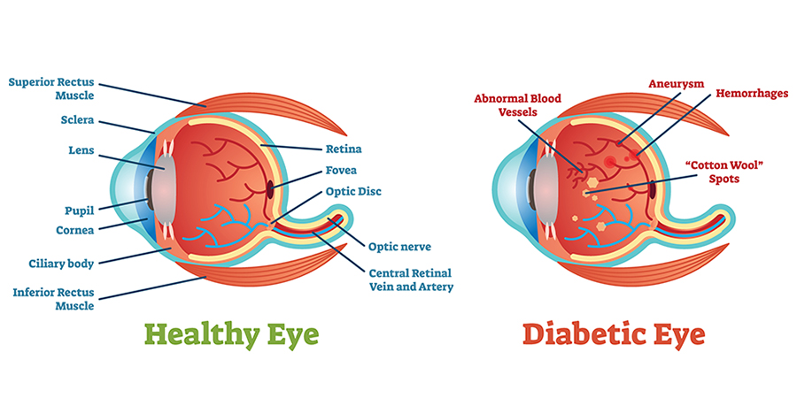 Dilation for Diabetes